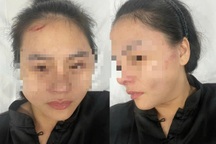 Cô gái kể lúc bị chủ nhà đánh trong quán ăn ở TPHCM