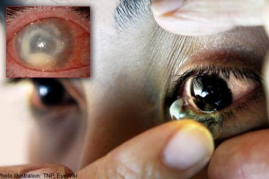 Bị amip “ăn” mắt do mang kính áp tròng suốt 6 tháng