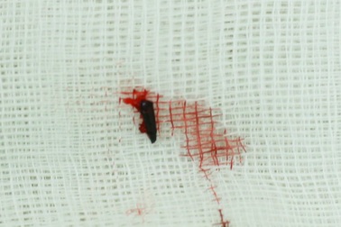 Hy hữu đầu bút chì nằm trong hốc mắt bé trai suốt 5 năm