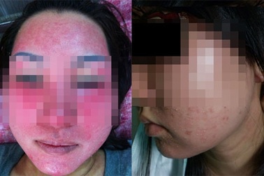 Người phụ nữ có biệt danh Bean và đơn hàng Collagen giả “khủng”