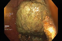 Tắc ruột sau ăn 3 quả hồng giòn