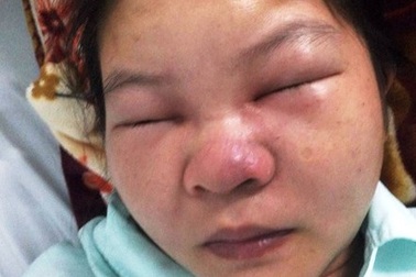 Cứu nữ bệnh nhân suýt chết vì… nặn mụn