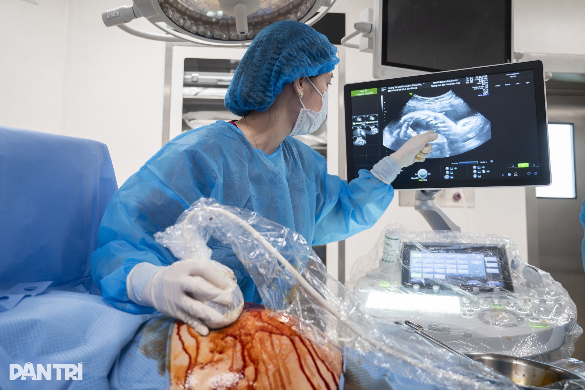 Doktor menggunakan jarum sebagai benang untuk menyelamatkan Bác sĩ dùng kim như sợi chỉ cứu “thiên thần” tràn dịch phổi trong bụng mẹ - 5