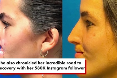 Cuộc sống hiện tại của người mẫu mất toàn bộ môi trên vì bị chó dữ tấn công