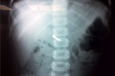 Quảng Bình: Nghịch đồ chơi, bé 5 tuổi nuốt đinh sắt vào bụng