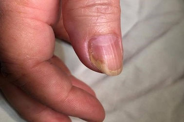 Người phụ nữ 5 năm treo tay lên đầu giường để ngủ