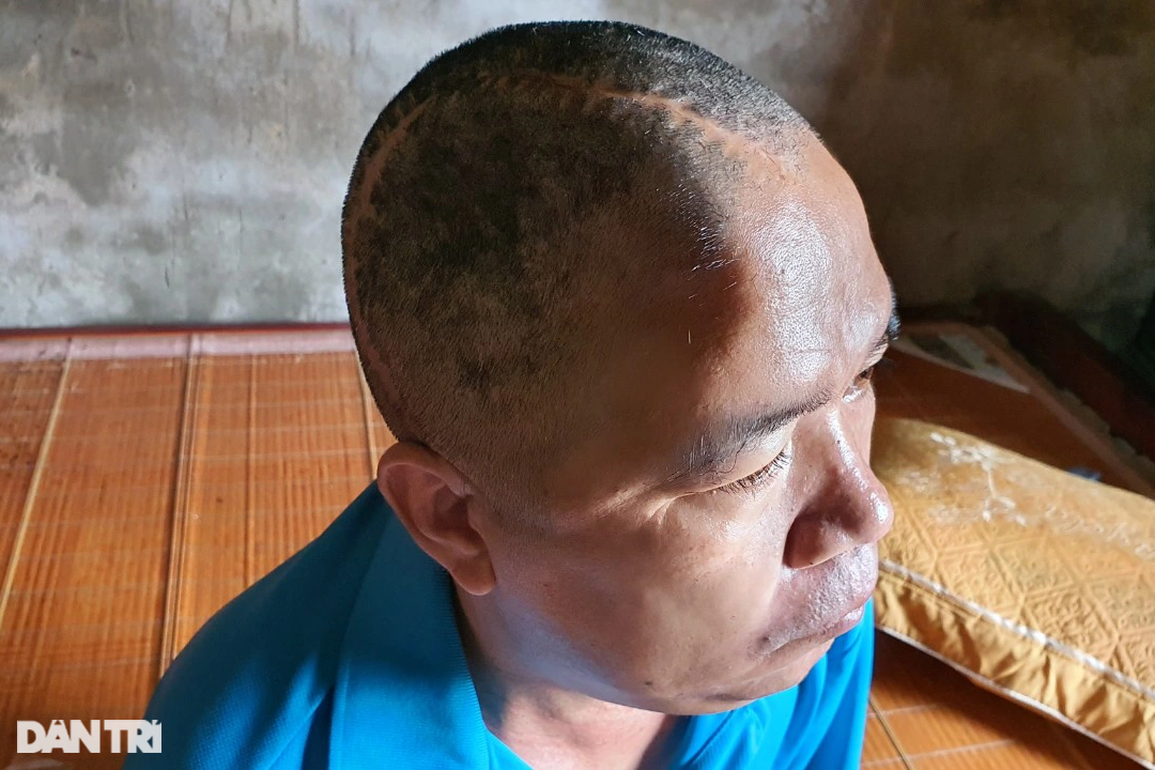 Bố ngã giàn giáo nằm liệt giường, 3 con thơ nguy cơ bỏ học giữa chừng - 1 Bố ngã giàn giáo nằm liệt giường, 3 con thơ nguy cơ bỏ học giữa chừng - 1