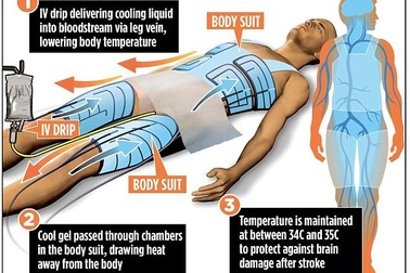 Thiết bị làm mát cứu bệnh nhân đột quỵ khỏi bị tổn thương não
