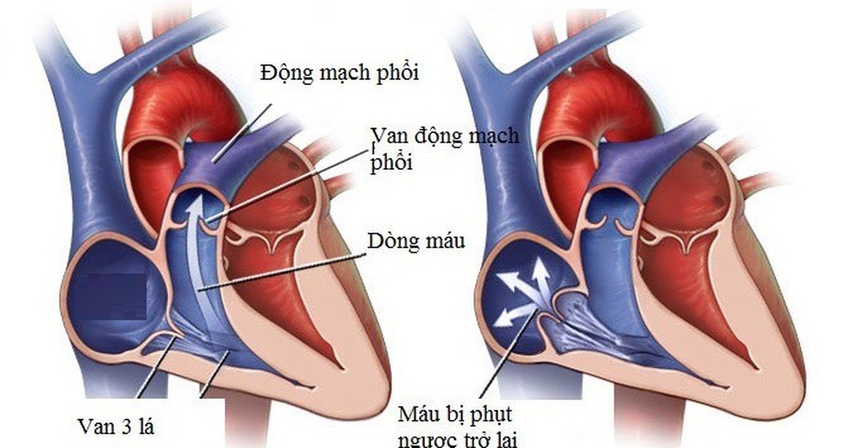 hở van tim 3 lá 1 4