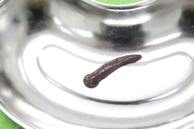 Kinh hoàng đỉa trâu sống ngoe nguẩy trong cổ họng bệnh nhân nhiều ngày