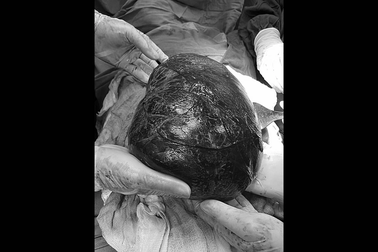 Cắt bỏ thành công khối u lớn chiếm gần hết ổ bụng bệnh nhân