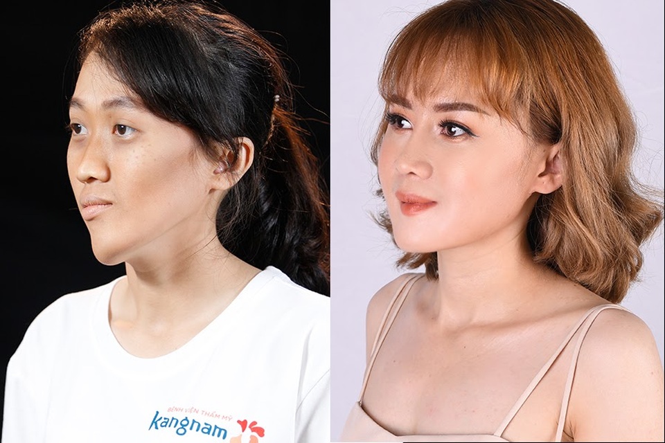 Cần tới 11 tiếng để thực hiện ca phẫu thuật khuôn mặt vặn xoắn hy hữu trong thẩm mỹ - 4