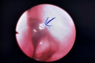 Bé gái 1 tuổi phải mổ cấp cứu trong đêm ở TPHCM vì "sinh vật lạ" trong mũi