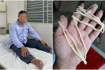 Sán dài 10m trong người vì mê nem sống, tiết canh