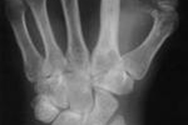 Bệnh viêm tủy xương