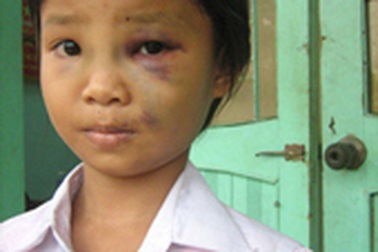 Bé gái mồ côi bị chú ruột hành hung dã man