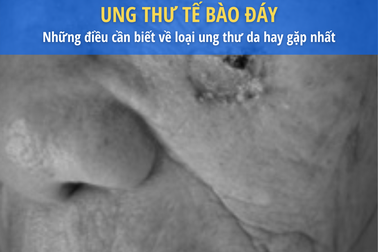 Cách bảo vệ da khỏi loại ung thư hay gặp nhất