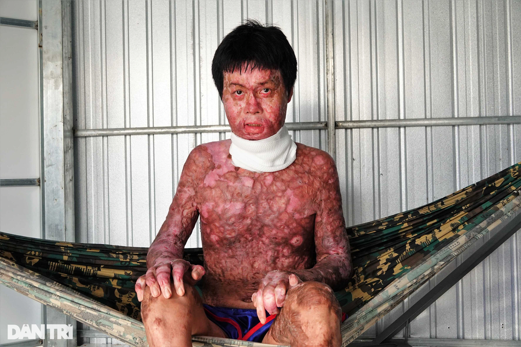 Trao hơn 87 triệu đồng tới người đàn ông bị bỏng trên 90% ở Hậu Giang - 2 Trao hơn 87 triệu đồng tới người đàn ông bị bỏng trên 90% ở Hậu Giang - 2