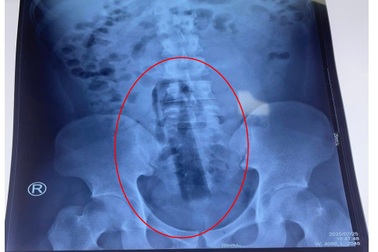 Nam thanh niên bị mắc kẹt cán cây lau nhà 15cm trong hậu môn