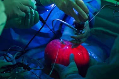 Đưa hẳn tử cung ra ngoài cơ thể để phẫu thuật cột sống cho thai nhi