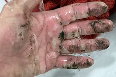 Sạc di động bất ngờ phát nổ khiến người dùng bỏng tay nghiêm trọng