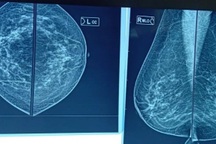 Bệnh Paget vú: Hiếm gặp, dễ bỏ sót và chẩn đoán nhầm