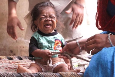 Hơn một tuổi đã ngừng lớn, nam thanh niên mắc kẹt trong hình hài đứa trẻ