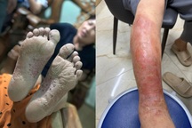 Cẩn trọng với bệnh vùng lũ: Một vết ngứa nhỏ có thể thành ổ nhiễm trùng