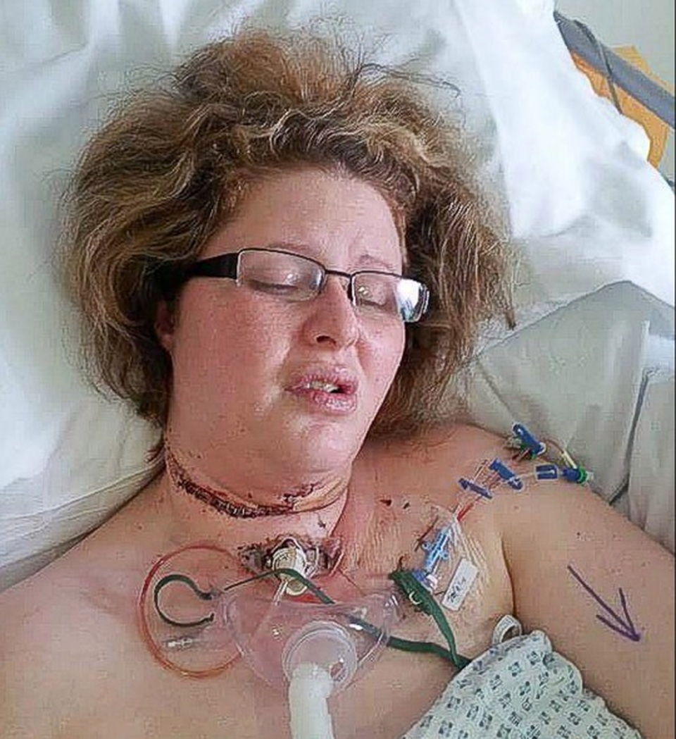 Thích hút thuốc, người phụ nữ trẻ phải cắt lưỡi vì ung thư - 1 Thích hút thuốc, người phụ nữ trẻ phải cắt lưỡi vì ung thư - 1