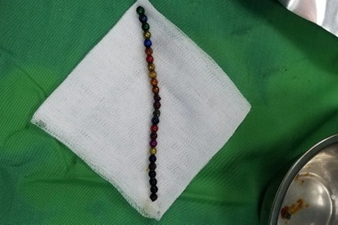 Bé 3 tuổi nuốt 25 viên bi nam châm vào bụng