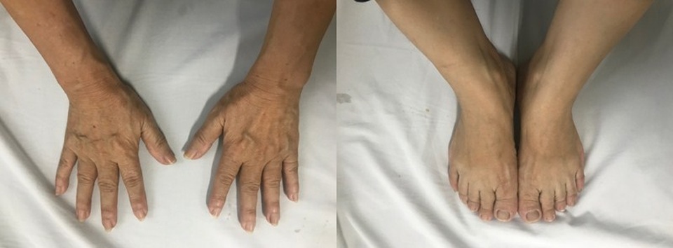Tưởng phát tướng vì tay chân to, mũi nở, không ngờ bệnh nguy hiểm - 1 Tưởng phát tướng vì tay chân to, mũi nở, không ngờ bệnh nguy hiểm - 1