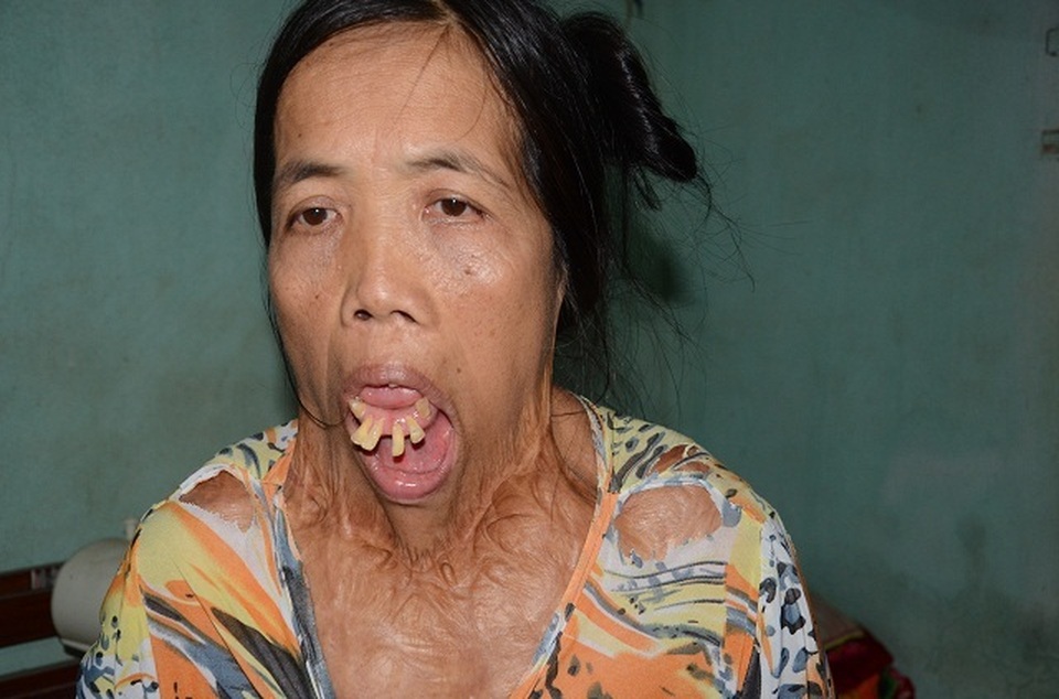 Người đàn bà nửa thế kỉ mang hàm răng “kỳ dị” thay đổi số phận sau 5 tháng - 11 Người đàn bà nửa thế kỉ mang hàm răng “kỳ dị” thay đổi số phận sau 5 tháng - 11