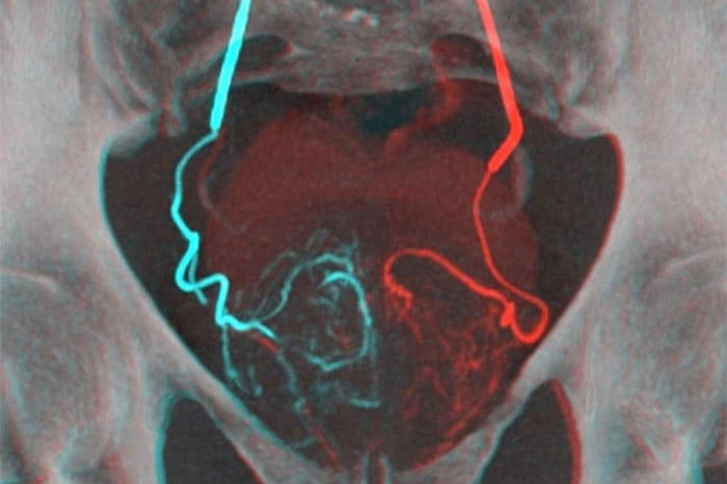 Điều trị u xơ tuyến tiền liệt không phải phẫu thuật - 1 Điều trị u xơ tuyến tiền liệt không phải phẫu thuật - 1