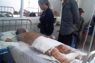 Nạn nhân vụ người đàn ông tự thiêu trong quán cà phê khó qua khỏi