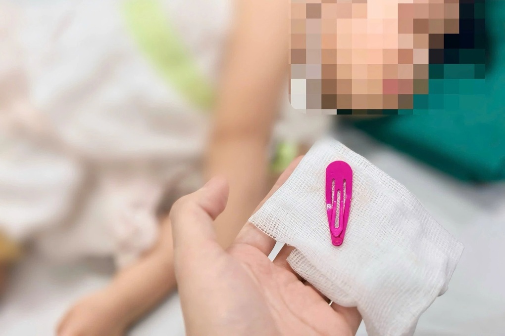 Hà Nội: Bé gái 21 tháng tuổi nuốt kẹp tóc vào bụng - 1 Hà Nội: Bé gái 21 tháng tuổi nuốt kẹp tóc vào bụng - 1