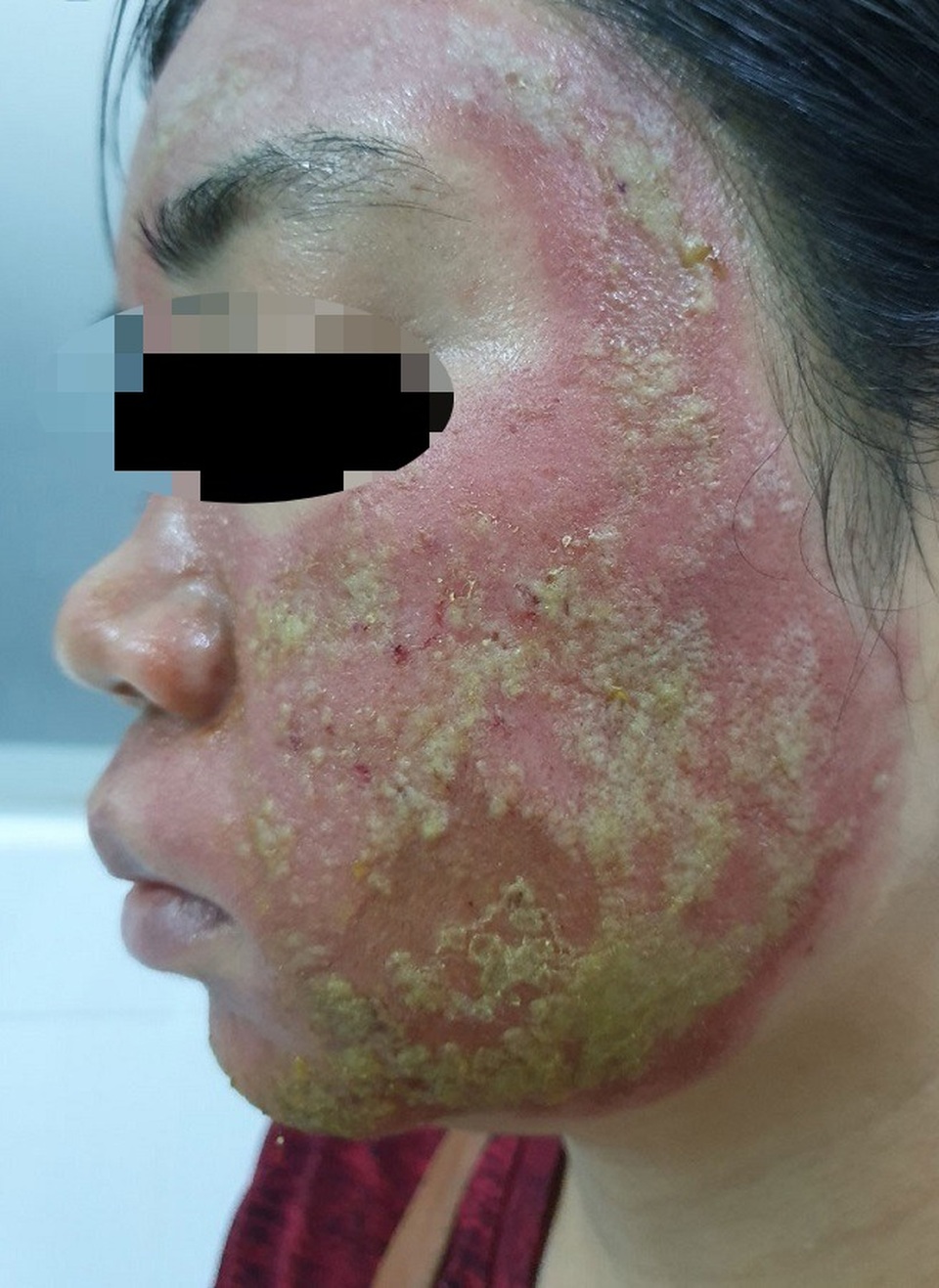Khuôn mặt “nát băm” sau khi chi 40 triệu đồng làm đẹp - 1 Khuôn mặt “nát băm” sau khi chi 40 triệu đồng làm đẹp - 1