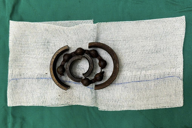 Bác sĩ dùng cưa máy cứu vùng kín chàng trai