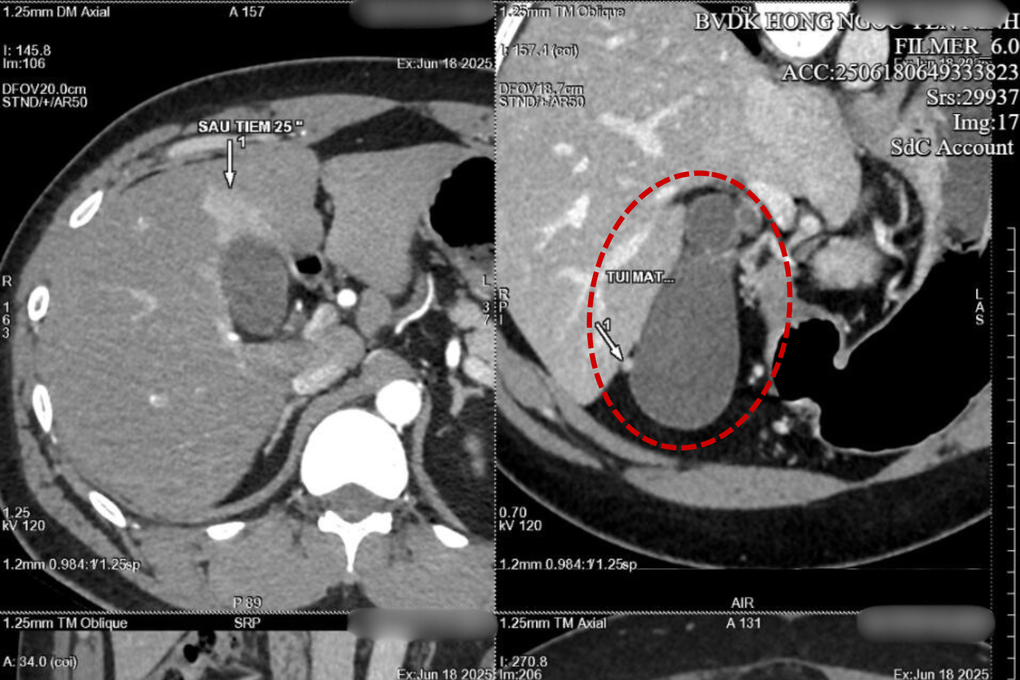 Giải pháp cắt cơn đau quặn bụng do sỏi túi mật - 1