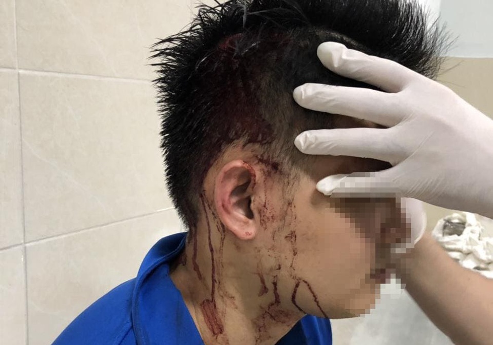 Nam thanh niên trúng 2 viên đạn bi vào đầu trong cuộc ẩu đả - 2 Nam thanh niên trúng 2 viên đạn bi vào đầu trong cuộc ẩu đả - 2
