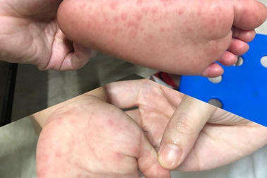 Bộ Y tế nói gì khi TPHCM kêu thiếu thuốc điều trị ca tay chân miệng nặng?