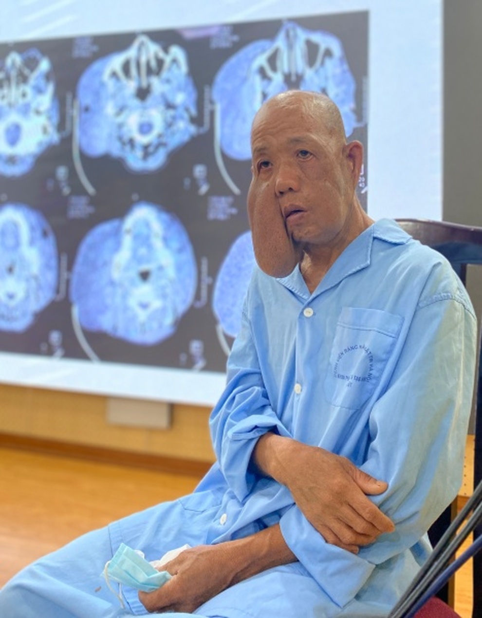 Khối u lớn ở má khiến người đàn ông bị biến dạng cả mặt - 1 Khối u lớn ở má khiến người đàn ông bị biến dạng cả mặt - 1