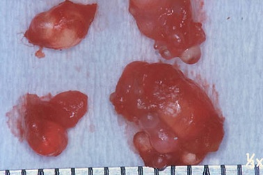 Đi siêu âm mới biết túi độn ngực bị vỡ