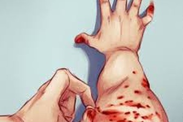 Ghiền nặn gãi da: Bệnh tâm thần kỳ quái!