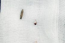 Bạn nghịch dại đặt bút bi dưới ghế, bé 12 tuổi chấn thương bìu nguy hiểm