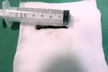 Con vắt “khủng” dài 8cm sống 2 tuần trong họng người đàn ông