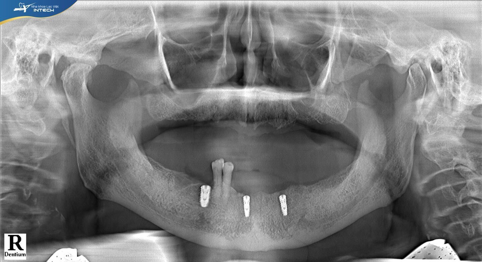 Kỳ tích: Cụ ông 94 tuổi cấy ghép implant toàn hàm thành công - 1 Kỳ tích: Cụ ông 94 tuổi cấy ghép implant toàn hàm thành công - 1