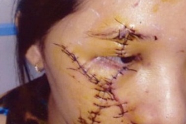 Bi đát cuộc đời thiếu nữ bị rạch mặt dã man vì cuộc chiến ngầm với “nữ hoàng quán nhậu”