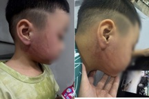 Công an điều tra vụ bé trai 4 tuổi nghi bị cô giáo đánh bầm tím mặt