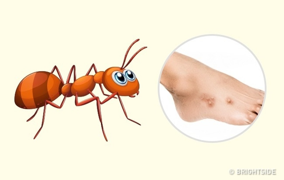 Cách phân biệt 10 vết côn trùng cắn - 7 Cách phân biệt 10 vết côn trùng cắn - 7