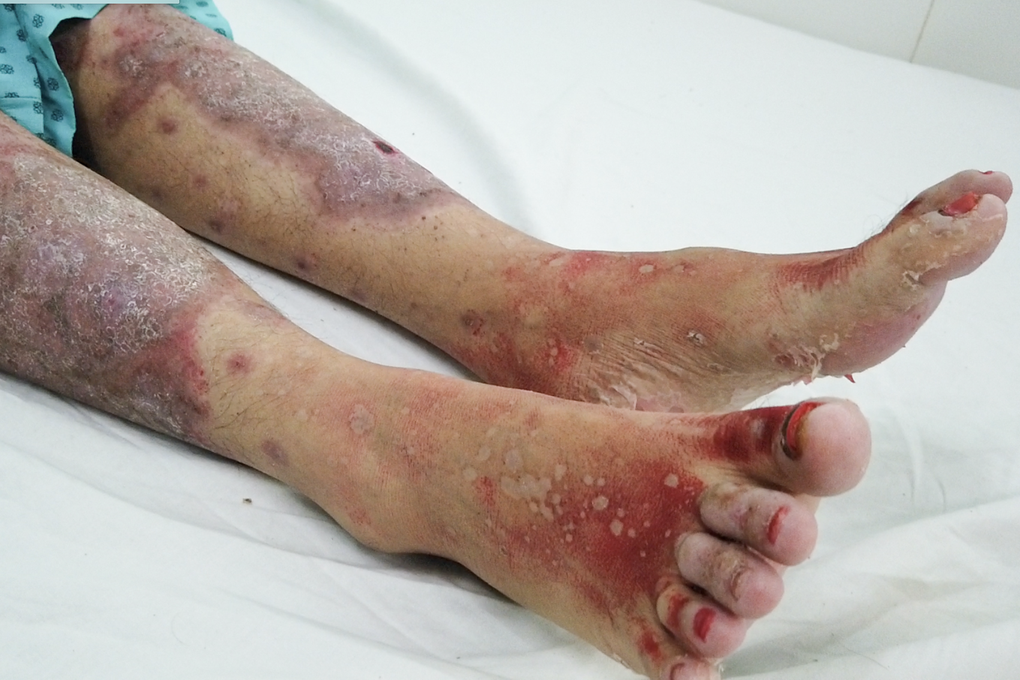 Cô gái bong tróc da toàn thân, nguy kịch sau khi uống thực phẩm chức năng - 1 Cô gái bong tróc da toàn thân, nguy kịch sau khi uống thực phẩm chức năng - 1